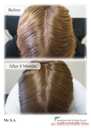 Australia Classifieds Recover from your loss with our natural hair loss treatment Gold Coast